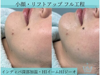 リメイククリニカルビューティー(Remake clinical beauty)/たるみ・もたつき改善