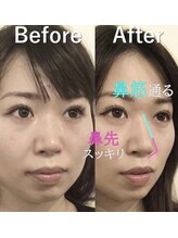 ラプリ 大宮店(Raplit)/隆鼻＋輪郭矯正40分10回