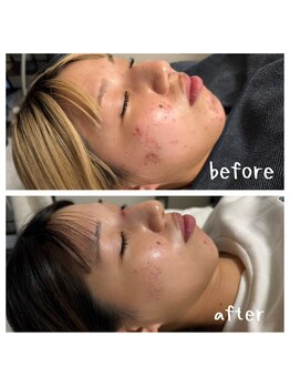 リーフィ 荻窪(Leafy)/ハーブピーリング