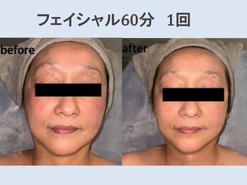 ete.rna【フェイシャル・毛穴ケア・ニキビケア】/ビフォーアフター