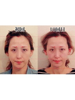 小顔22 ボルティ 本店(Bolty)/【悩み】面長