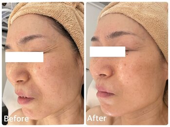 ナビ(NABI)/SNS話題!エクソソーム導入