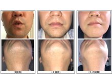 ココネローズ 福津サロン(Cocone Rose)/脱毛