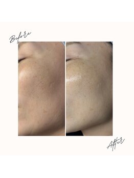 イチロクイチハチ(1618)/美白×抗酸化集中プログラム