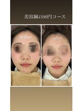 フォーユー 大和郡山院(for you)/美容鍼ビフォーアフター