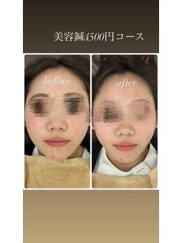 フォーユー 大和郡山院(for you)/美容鍼ビフォーアフター