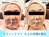 【夏期限定♪】毛穴ケア+タルミ改善+シミケア★（６０分）￥6,300→