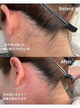 サロンドベルム(Salon de BELME)/ダブル脱毛：before/after