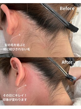 サロンドベルム(Salon de BELME)/ダブル脱毛:before/after