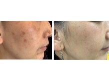 エステティックセラピー プレマ(PREMA)/毛穴＆シミ改善ホームケアで叶う