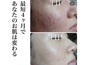 ネムレル森(Nemureru森)/ハーブピーリング