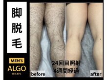 アルゴ 山口店(ALGO)/メンズ脱毛