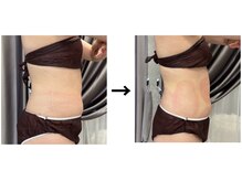 ドクターエイジレス(DR.AGELESS)/脂肪冷却コース1回