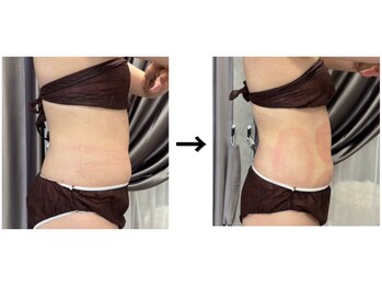 ドクターエイジレス(DR.AGELESS)/脂肪冷却コース1回