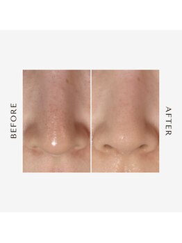 ヒヨリ(hiyori)/《before/after》毛穴洗浄