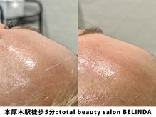 ベリンダ(BELINDA)/フェイスワックス脱毛