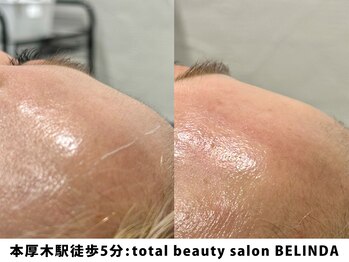 ベリンダ(BELINDA)/フェイスワックス脱毛