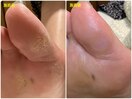施術　ヒールタコもスッキリ♪