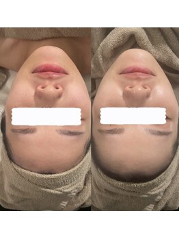 ホワイトアクア 中目黒店(WHITE AQUA)/ハーブピーリング/毛穴/中目黒