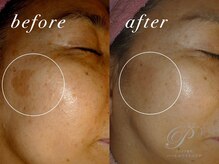 パールホワイトニングサロン 町田店/大きいシミ/老半改善で劇的変化