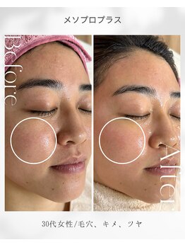 アネラ(ANERA)/毛穴/メソプロプラス