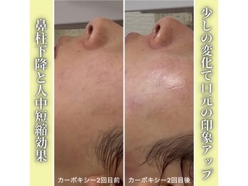 ハニエル(Haniel)/カーボキシー症例