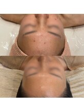 ジャストミービューティー(Just Me Beauty)/肌質改善/毛穴ケア/ニキビケア