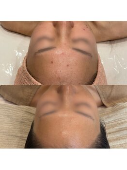 ジャストミービューティー(Just Me Beauty)/肌質改善/毛穴ケア/ニキビケア