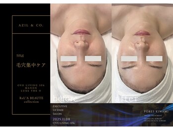 オーヴォ リビングスパ アネックス マノン(OVO LIVING SPA annex MANON)/【施術事例】毛穴集中ケア
