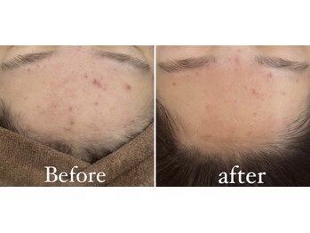 ロザブルー(ROSA BLU)/Before/after