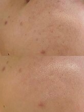 ユウビ ビューティー サロン(Yuubi)/【peel stage】ハーブピーリング