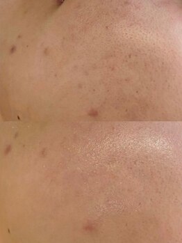 ユウビ ビューティー サロン(Yuubi)/【peel stage】ハーブピーリング