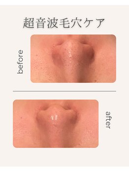 カオヤ プラス(Kaoya plus)/超音毛穴ケア◎ビフォーアフター