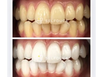 セルフダック 宮城角田店(SELFDUCK)/セルフホワイトニング症例写真