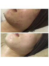 リラーナ(Re rana)/大人ニキビケア♪