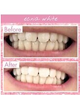 エクシアホワイトニング 中野駅北口店/ホワイトニングビフォーアフター