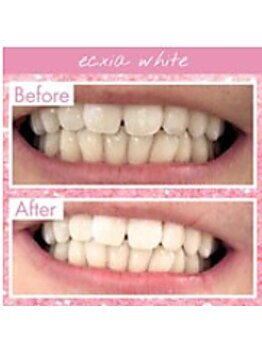 エクシアホワイトニング 中野駅北口店/ホワイトニングビフォーアフター