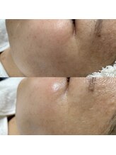 ナル(NaLu)/フェイシャルワックス