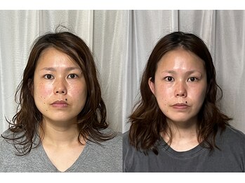 美容整体 アルマ/エラへの施術10回目