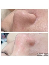 マル ン(Malu'n)/メンズの鼻角栓除去