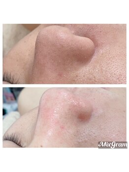 マル ン(Malu'n)/メンズの鼻角栓除去