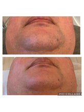 リシア(Re.sia)/メンズ髭脱毛１０回後