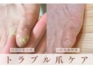 トラブル爪ケア