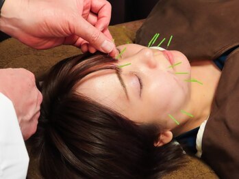 大勝鍼灸整骨院プライマリィの写真/電気美容鍼とは・・・顔のツボに鍼を刺し、そこに電気を流して肌や筋肉を活性化!リフトUPした憧れの小顔へ!