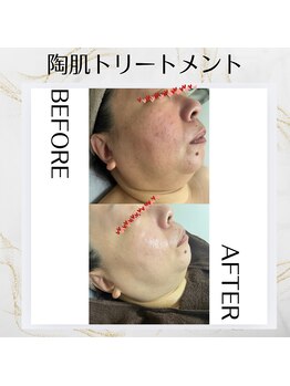 キラリ(Kirari)/次世代ハーブピーリング