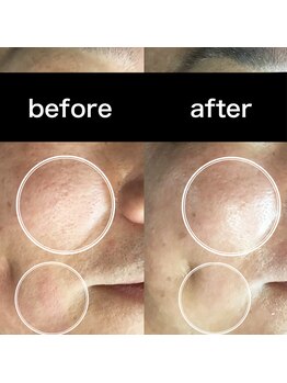 アウラ(AURA)/毛穴洗浄で毛穴が小さく!!