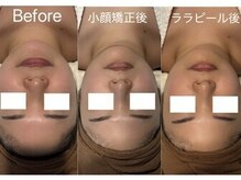 アイラブワン(eye love one)/小顔矯正×ララピール【桜ケ丘】