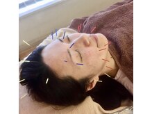 まっさ鍼灸整骨院 京王堀之内院の雰囲気（リフトアップ美容鍼！即効性あり。是非お試しください♪）