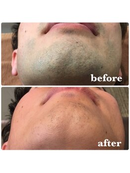 アンク(AnnC)/髭脱毛