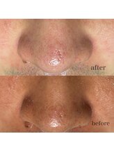 シャルム ド ケー(charme de k)/最強毛穴洗浄